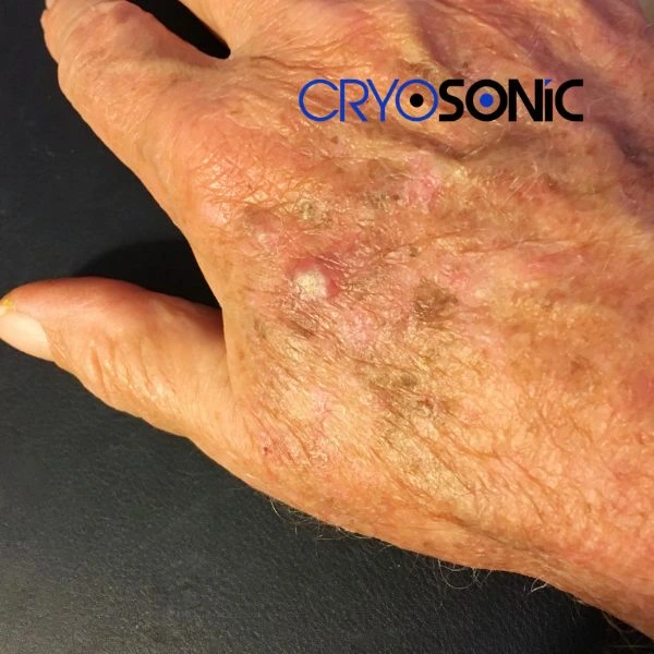 Understand more about actinic keratosis treatment today Glossop